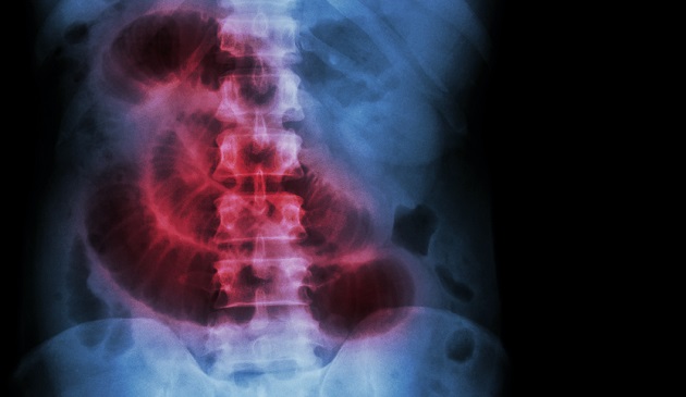 Vi Mangler Fortsat En Effektiv Behandling Af Postoperativ Ileus