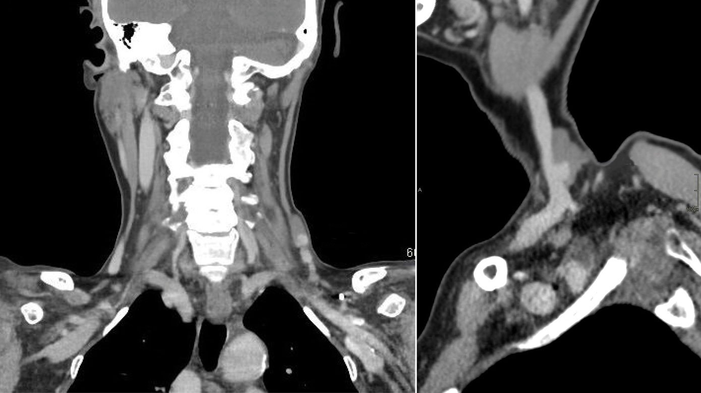 Trombose og pseudoaneurisme i vena jugularis Ugeskriftet.dk