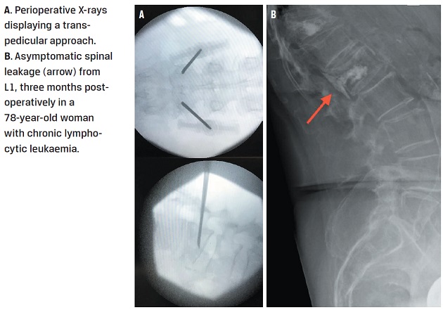 Minimally invasive management of malignant vertebral compression ...