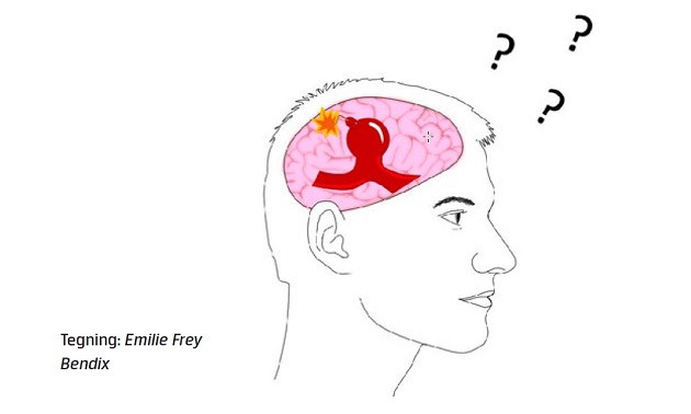 Ikkerumperede Intrakranielle Aneurismer Skal Ikke Altid Opereres ...