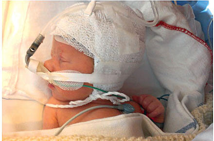Prædiktorer for bronkopulmonal dysplasi og pulmonal hypertension nyfødte børn