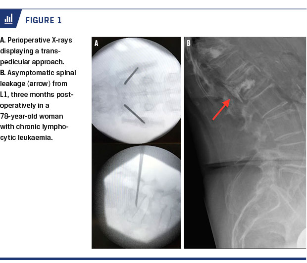 Percutaneous Vertebroplasty for Osteoporotic Compression