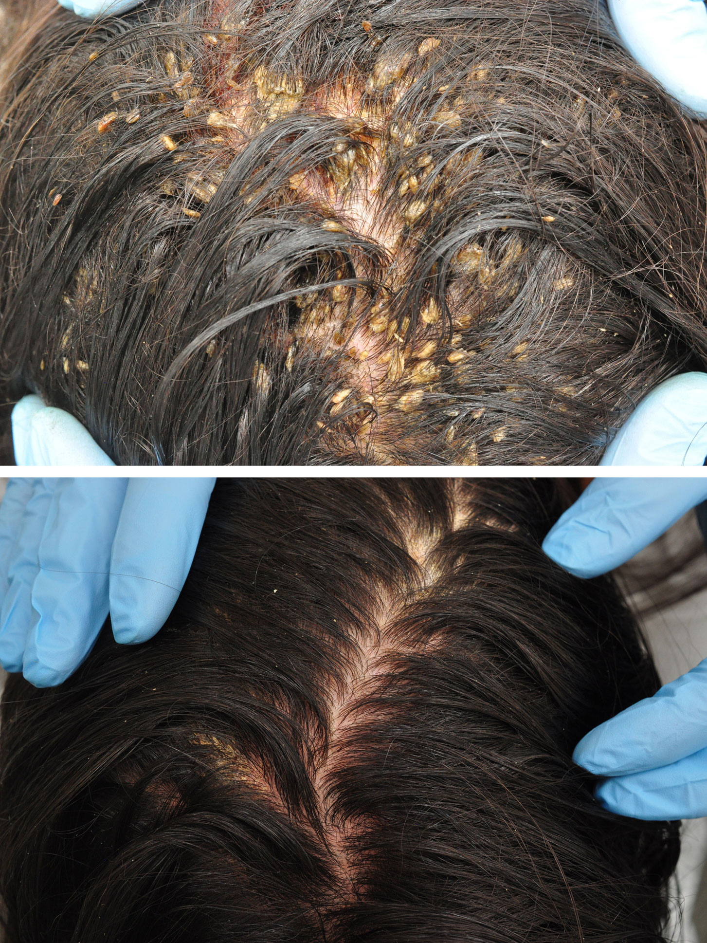 Pityriasis Amiantacea Diagnosis Of Scalp Rashes Dermn - vrogue.co