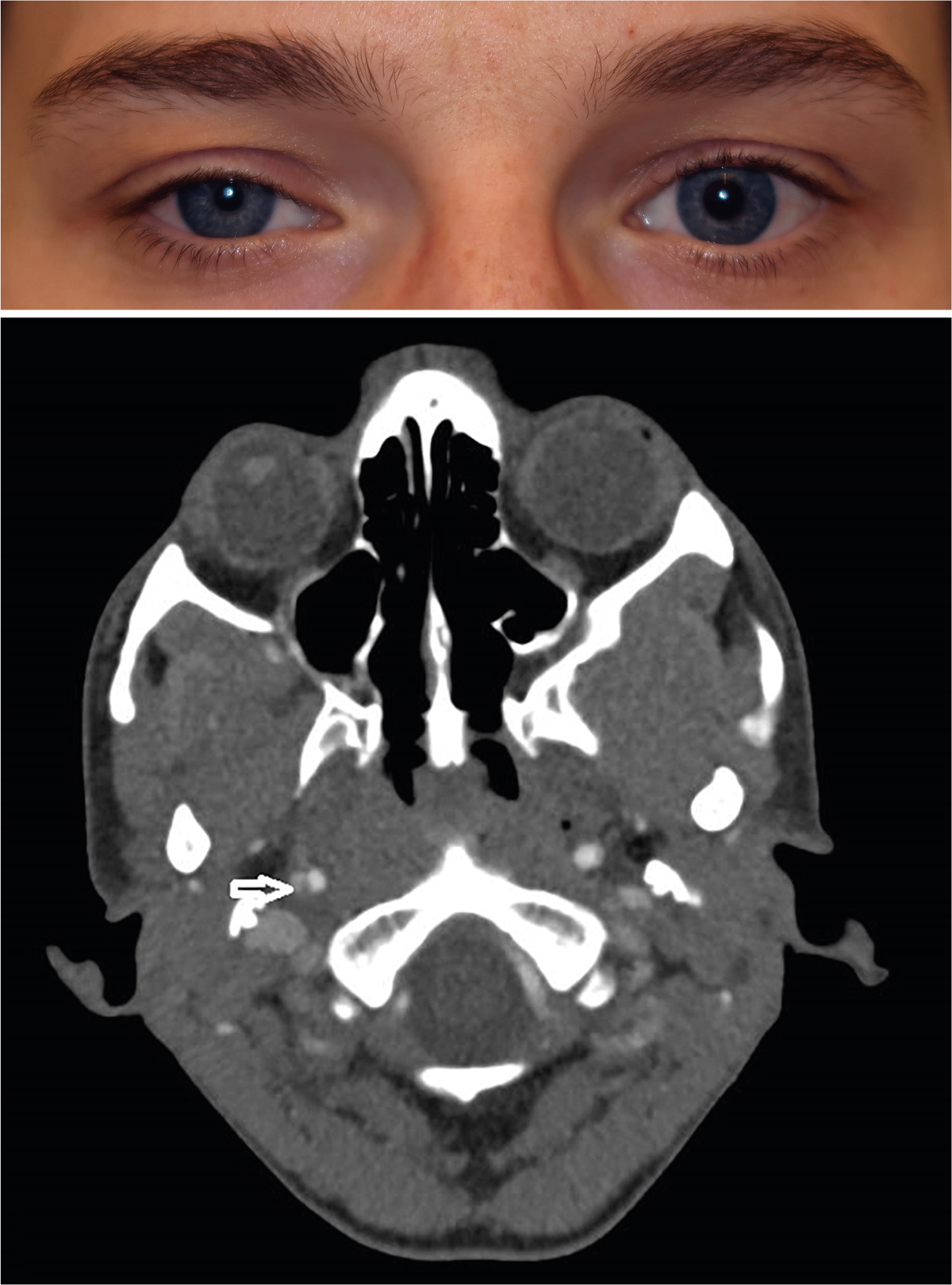 Akut opstået Horners syndrom som tegn til carotisdissektion Ugeskriftet.dk