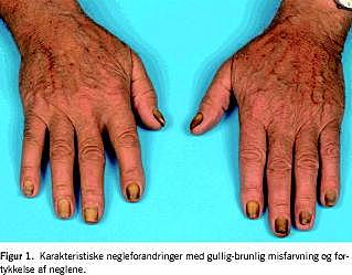 Anbefalede gå på arbejde tildeling Yellow nail-syndrom | Ugeskriftet.dk