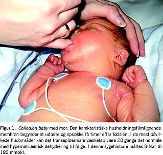 lugt Bevæger sig ikke kristen Svær hypernatriæmisk dehydrering hos collodion baby | Ugeskriftet.dk