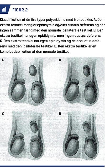 Polyorkisme er en sjælden årsag i scrotum | Ugeskriftet.dk
