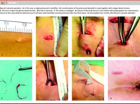 Pilonidal Cystectomy Technique: Approach Considerations, Simple Cystectomy,  Techniques for Complicated or Recurrent Disease