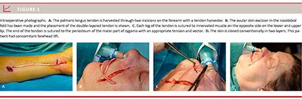 Rehabilitation of facial paralysis using autogenous fascia lata