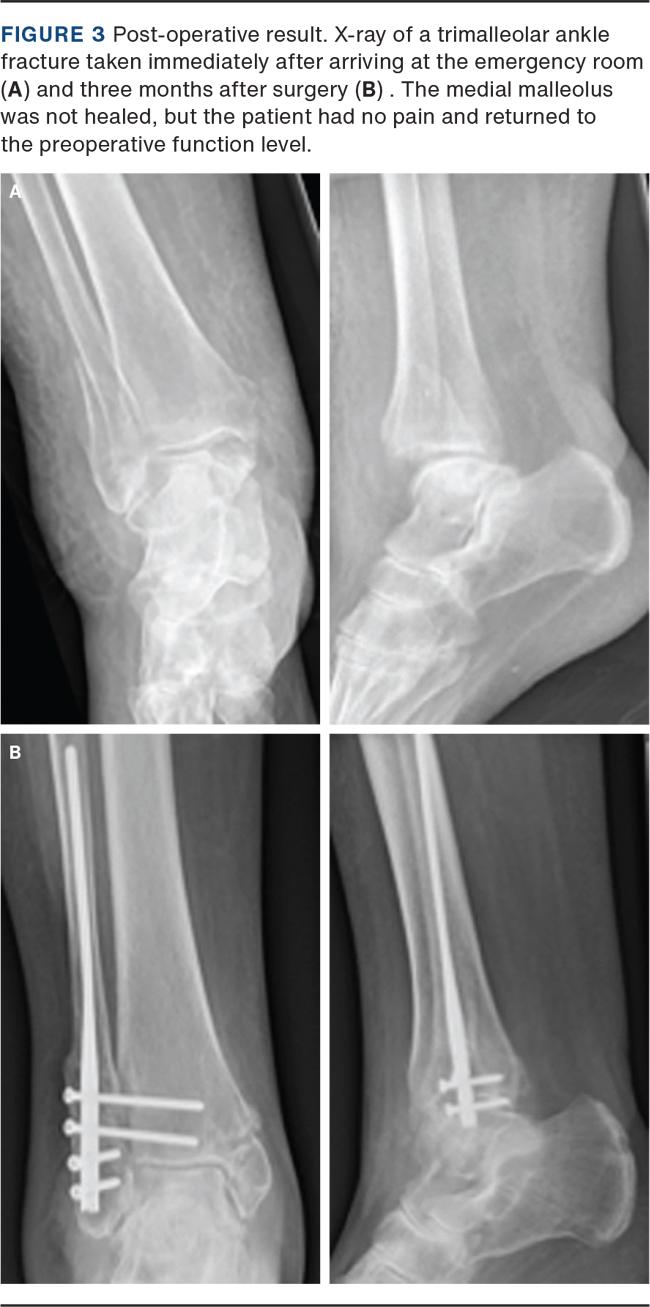 Ankle fracture: Lateral malleolar fixation using Acumed Fibula Rod System  Surgical Technique - OrthOracle