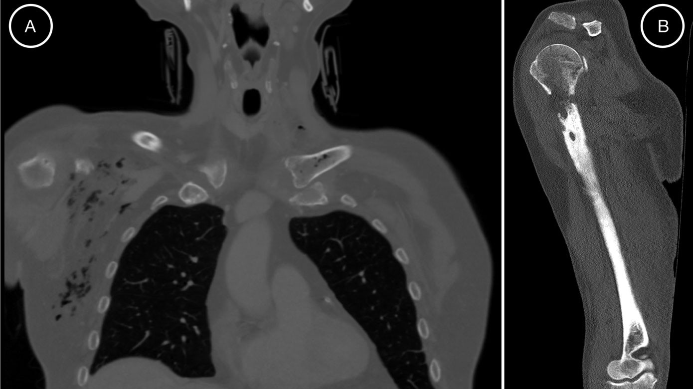 Kronisk emfysematøs osteomyelitis Ugeskriftet.dk